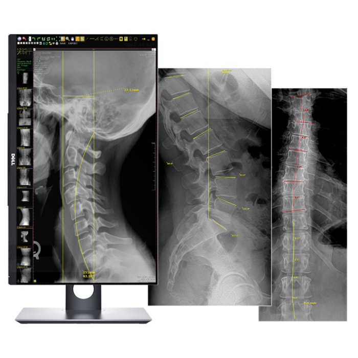 20/20 CFPW Wireless 14X17 Chiropractic Direct Digital Imaging System - DR PANEL