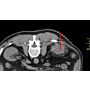 Fast Find Grid for CT Biopsies